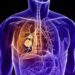 Lungs Problem